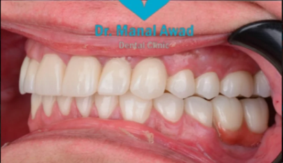 After Dental Implant
