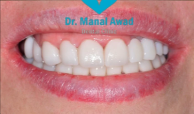 After Dental Implant