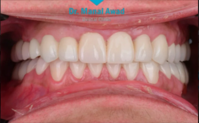 After Dental Implant
