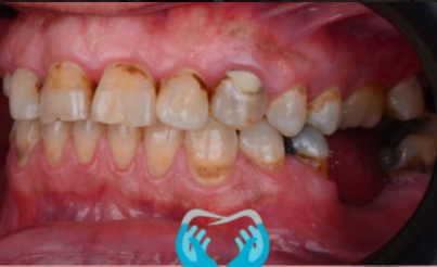 Before Dental Implant Transformation