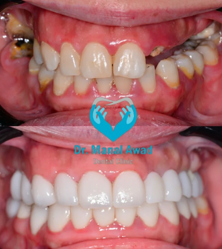 Cosmatic dentistry In Jordan 1